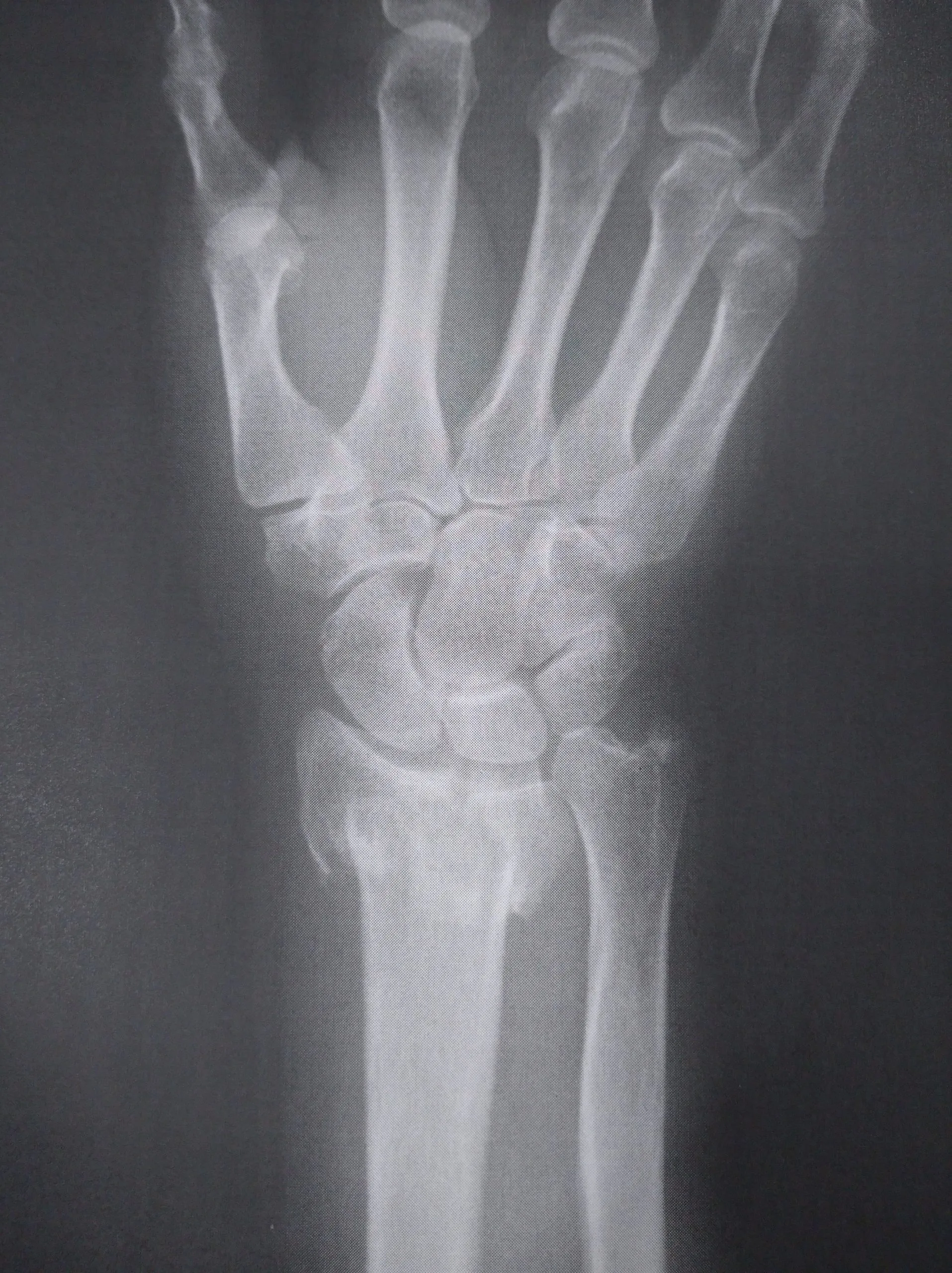 橈骨遠位端骨折 ささくら整形と手のクリニック